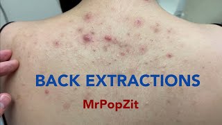 Tons of blackheads on the back Acne extractions Blackheads and whiteheads Mining pore dirt [upl. by Otilrac]