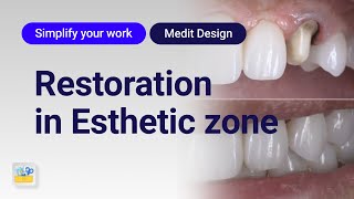 Simplify your work  Esthetic restoration [upl. by Delastre]