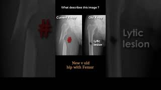 New v old Hip with Femur 12 Musculoskeletal Xray Viewing principles radiologychannel007 [upl. by Zorana946]