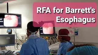 RFA for Barretts Esophagus \\ BARRX RFA System Basic Preparation [upl. by Reni]