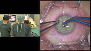 ICRS Intracorneal Ring Segment implantation in a case of moderate sag keratoconus [upl. by Ellehsat]