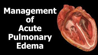 Management of Acute Pulmonary Edema [upl. by Bolen]