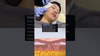 Subsisi Bopeng  Subcision Treatment for Scars [upl. by Neelac]