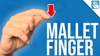 Cant Lift Your Fingertip   Mallet Finger  Part 1 [upl. by Larrabee]