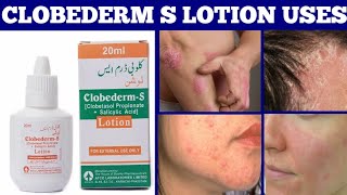 Clobederm S Lotion Uses in Urdu Clobederm S Lotion Benefits Eczema Psoriasis Treatment [upl. by Rosmunda]