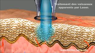 Le traitement de la couperose au laser  Dr Barry [upl. by Phylis]