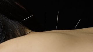 How does Acupuncture work Alberta College of Acupuncture amp Traditional Chinese Medicine Calgary [upl. by Willtrude]