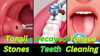 asmr tonsil stone removal animation decayed teeth and cleaning tongue [upl. by Bradshaw]