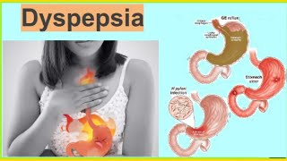 Dyspepsia  Functional Dyspepsia  Organic Dyspepsia Heart Burn Hindi  UrduTडिस्पेप्सिया [upl. by Ahsilek]