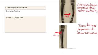 Common Pediatric Fractures  MSK  Step 1 Simplified [upl. by Halpern]