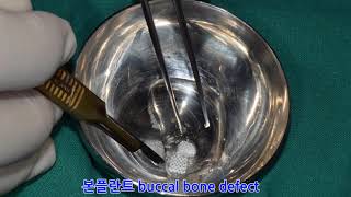 Buccal Bone Dedect 본플란트 에스겔의 BONEPLANT [upl. by Sussman]