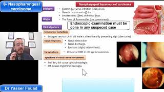 6 Nasopharyngeal Carcinoma [upl. by Aissela]