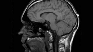 Magnetic resonance imaging of my head [upl. by Yenots164]