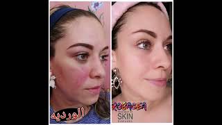 Rosacea الورديه [upl. by Lambard]