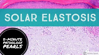 Solar Elastosis 5Minute Pathology Pearls [upl. by Eigriv]