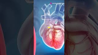 How a Stent is Placed in the Heart Animated shorts angioplasty health heart healthylifestyle [upl. by Poppo]