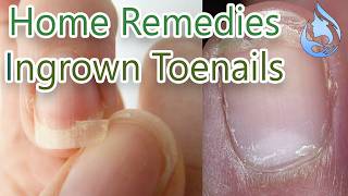 Home Remedies for Ingrown Toenails [upl. by Leary328]