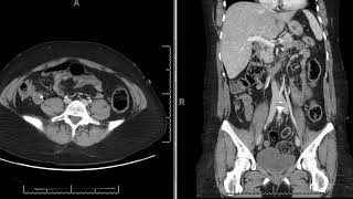 mesenteric adenitis [upl. by Faubion]