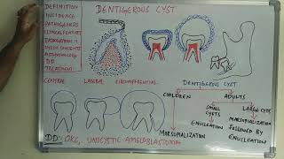 Dentigerous cyst [upl. by Ina]