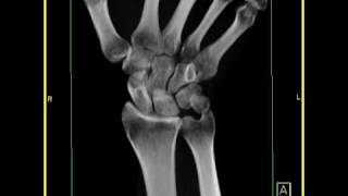 Wrist Anatomy Healing fracture of the scaphoid with a small cyst 1 of 2 [upl. by Ymac]