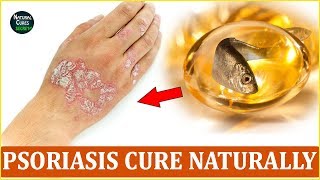 How To Cure Psoriasis Naturally  Psoriatic Arthritis Treatment at Home [upl. by Tavy]