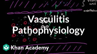 Vasculitis pathophysiology  Circulatory System and Disease  NCLEXRN  Khan Academy [upl. by Niela]