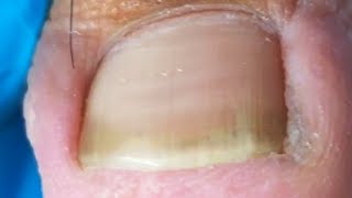 Wonderful ingrown toenail trimming Remove excess dead skin [upl. by Kopple]