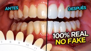 ✅ ¿Cómo realizar un blanqueamiento dental Opalescence boost ultradent 5 pasos para blanquear [upl. by Epps]