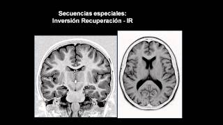 introducción a las neuroimágenes [upl. by Stephine]