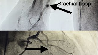 Brachial Loop in Acute Extensive Anterior MI and Thrombus Grade V How To Deal With [upl. by Airtemed253]