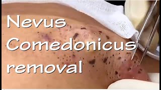 Nevus Comedonicus removal  Video 3 of 3 The ultimate quotblackheadquot removal video [upl. by Oakie197]