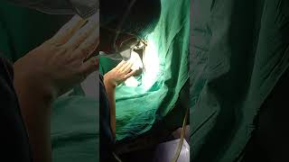 How to do spinal anesthesia before cesarean delivery [upl. by Yeoj]