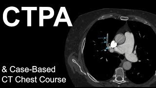 CT Pulmonary Angiogram Pulmonary Embolism CaseBased Course [upl. by Eeima]