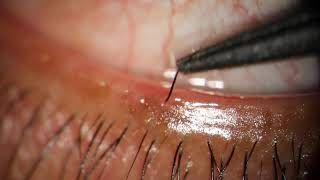 Removing Eyelash Growing Into Eye through Meibomian Gland [upl. by Lyall]