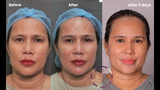 Fox eye thread lift  under eye Derma threads  and skin glow with Eladerm and skin boosters [upl. by Reniar]