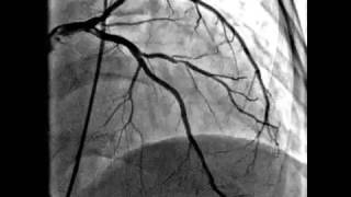 Coronary artery angioplasty video [upl. by Cod]