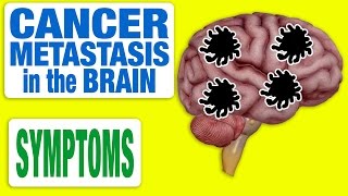 Cancer Metastasis in the Brain  All Symptoms [upl. by Nanam]