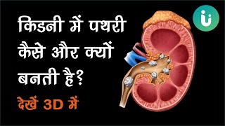 किडनी में पथरी कैसे बनती है और इसे कैसे निकालें  देखें 3D में  Kidney stone treatment in Hindi [upl. by Ientruoc]