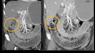 MDCT of the Small Bowel and Mesentery Inflammatory Disease Part 1 [upl. by Meldon]