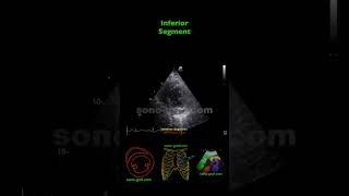 Echocardiography  Inferolateral And Inferior Hypokinesia [upl. by Jorey340]