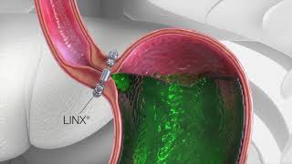 LINX Reflux Surgery Animation [upl. by Accem]