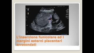 Studio ecografico della placenta impatto sul benessere materno e fetale  Displasia mesenchimale [upl. by Aluk]