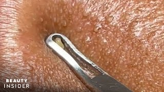 How Lip Blackheads Are Extracted  Beauty Insider [upl. by Nakada]