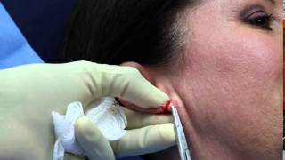 Torn earlobe repair in 15 minutes  13 second video [upl. by Pall244]