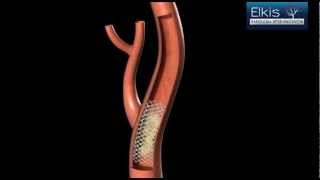 Angioplastia de artéria carótida protegida com Stent  Técnica cirúrgica Endovascular [upl. by Sheldon]