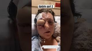 Update Part 2 Post Eye Flap Surgery mycancerjourney headandneckcancer [upl. by Asiluy478]