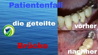 Patientenfall  Geschiebebrücke  geteilte Brücke im Unterkiefer  vorher  nachher [upl. by Negaet]