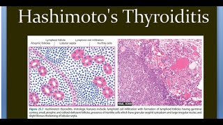 Pathology 811 a Hashimoto Thyroiditis inflammation Thyroid Auto immune CTLA4 PTPN22 Painless [upl. by Dryfoos61]