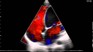 ECOCARDIOGRAMA MIOCARDIOPATIA DILATADA [upl. by Garald]