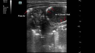 NEC Air in Bowel Wall consistent with Pneumatosis Intestinalis [upl. by Aggy]